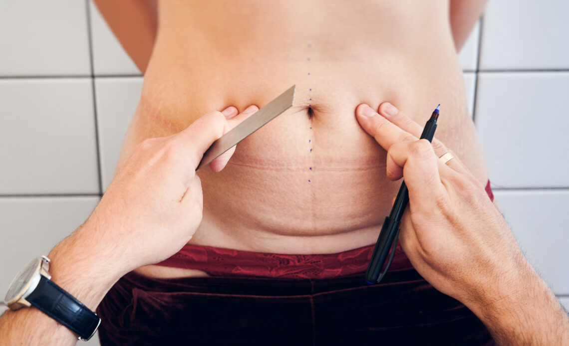 abdominoplastie