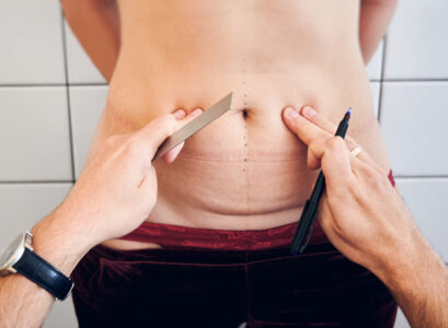 abdominoplastie